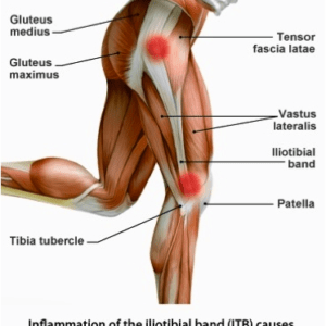 Pain can occur anywhere along the TFL and IT Band, most commonly felt in the outside of the knee.