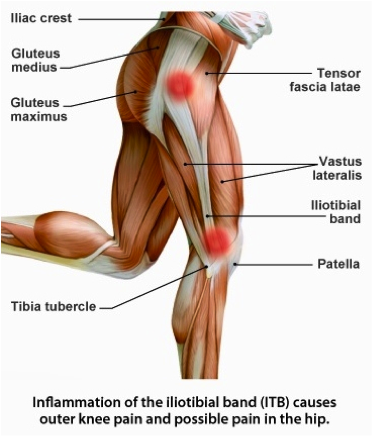 Causes of IT Band Syndrome – XCEL Sports Clinic