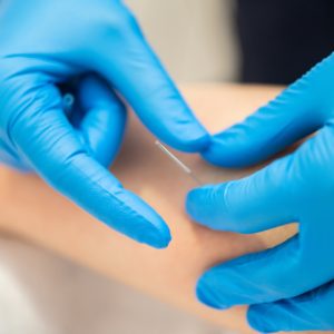 Hands of physiotherapist doing a dry needling